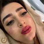 تزریق ژل و فیلر، کلینیک زیبایی مهدخت
