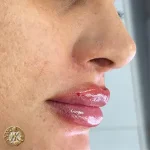 تزریق ژل و فیلر، کلینیک زیبایی مهدخت