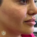 تزریق ژل و فیلر، کلینیک زیبایی مهدخت