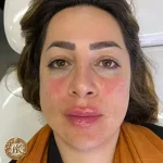 تزریق ژل و فیلر، کلینیک زیبایی مهدخت