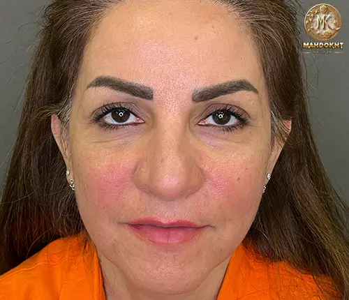 اصلاح خط خنده