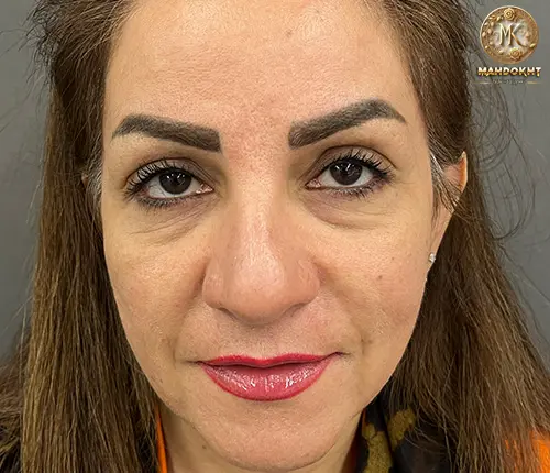 اصلاح خط خنده