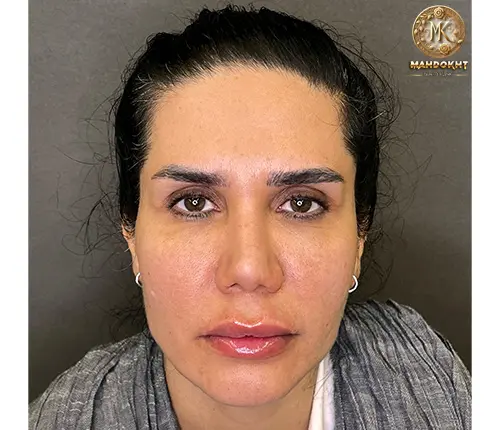 فیلر زاویه فک