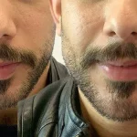 مادلینگ صورت، زاویه سازی فک