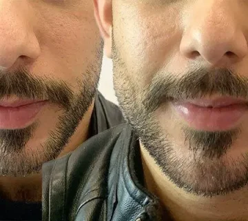 مادلینگ صورت، زاویه سازی فک