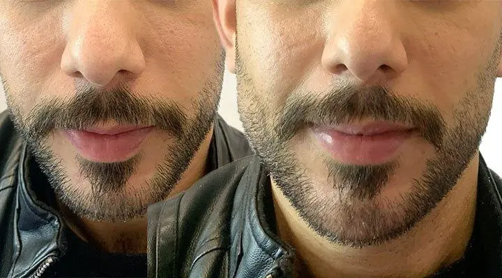 مادلینگ صورت، زاویه سازی فک