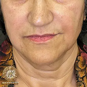 جوانسازی صورت - بعد