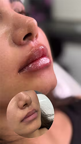 فيلر الشفايف الروسي