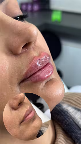 فيلر الشفايف الروسي