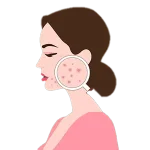 سابسیژن Subcision سابسیژن Subcision