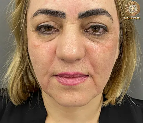 لیفت با نخ - قبل