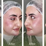 رفع تیرگی زیر چشم