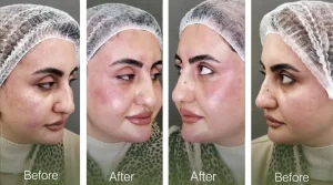 رفع تیرگی زیر چشم