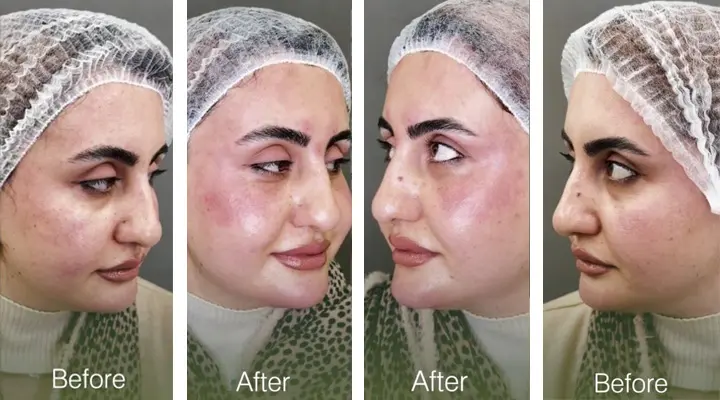 رفع تیرگی زیر چشم