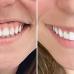 اصلاح لبخند لثه ای با بوتاکس