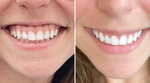 اصلاح لبخند لثه ای با بوتاکس