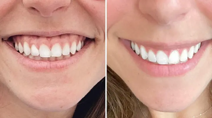 اصلاح لبخند لثه ای با بوتاکس