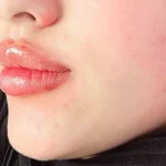 تزریق فیلر لب در شیراز
