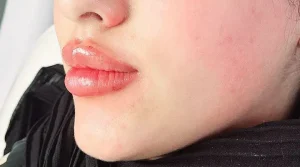 تزریق فیلر لب در شیراز