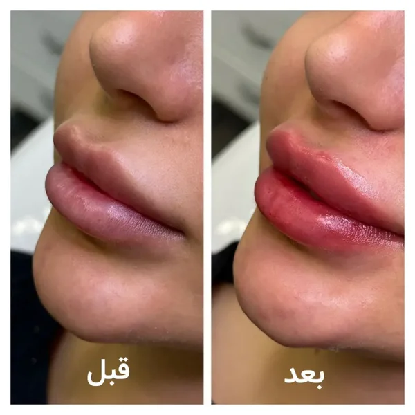 تزریق ژل لب
