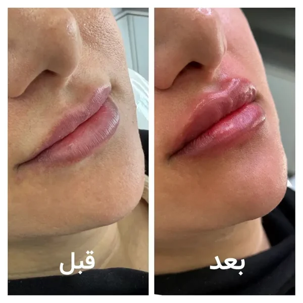 تزریق ژل لب