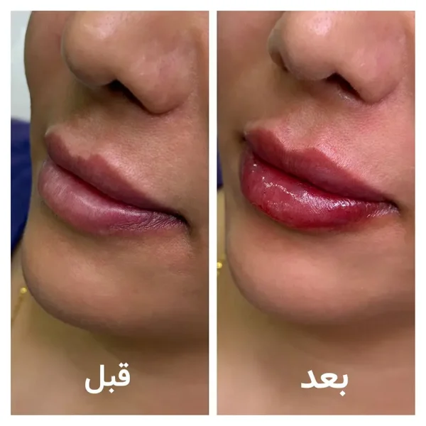 تزریق ژل لب