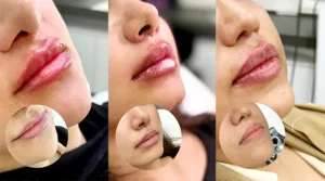 تزریق فیلر لب در شیراز