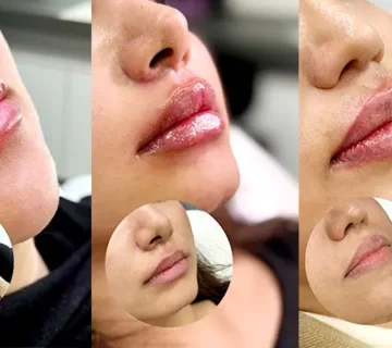 تزریق فیلر لب در شیراز