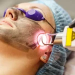 پیلینگ کربن