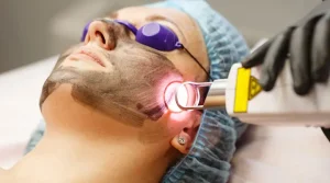 پیلینگ کربن