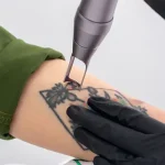 پاک کردن تتو با لیزر