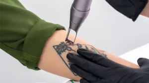 پاک کردن تتو با لیزر