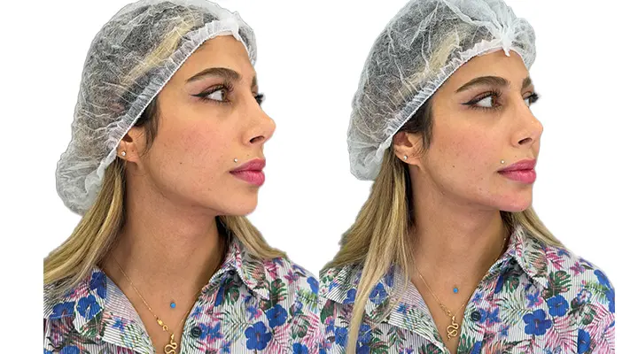 تزریق فیلر چانه