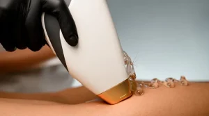 لیزر موهای زائد در شیراز