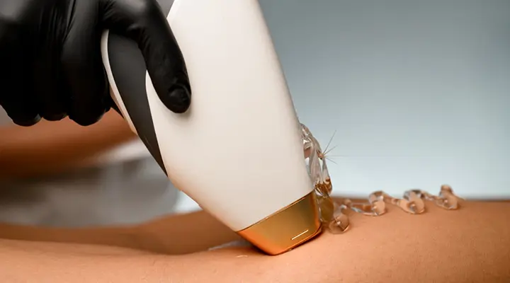 لیزر موهای زائد در شیراز