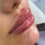 تزریق ژل لب
