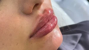 تزریق ژل و فیلر