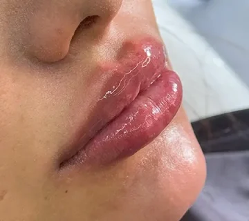 تزریق ژل و فیلر