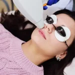 لیزر موهای زائد صورت زنان