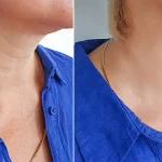 جوانسازی گردن بدون جراحی