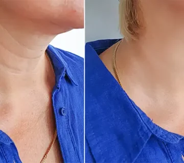 جوانسازی گردن بدون جراحی