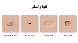 انواع اسکار