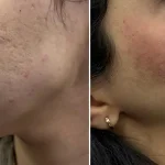 سابسیژن، درمان جای جوش و اسکار آکنه