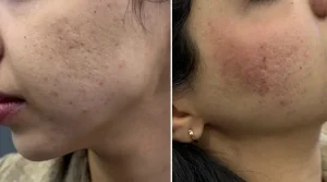 سابسیژن، درمان جای جوش و اسکار آکنه