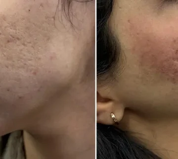 سابسیژن، درمان جای جوش و اسکار آکنه