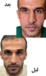 فیلر زیر چشم و فول فیس