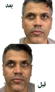 فیلر زیر چشم