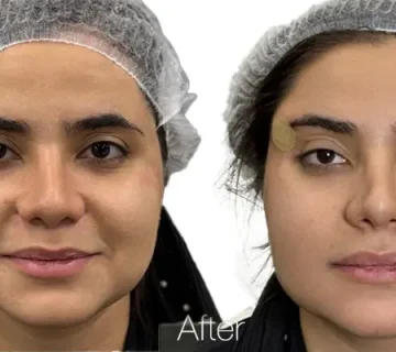 لیفت ابرو با نخ