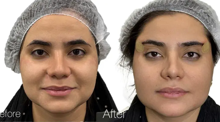 لیفت ابرو با نخ