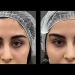 لیفت چشم با نخ